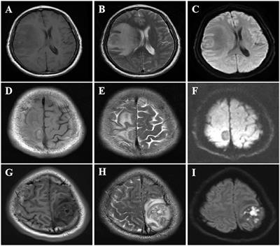 Case report: Cerebral syphilitic gumma: a case retrospective report of eight cases